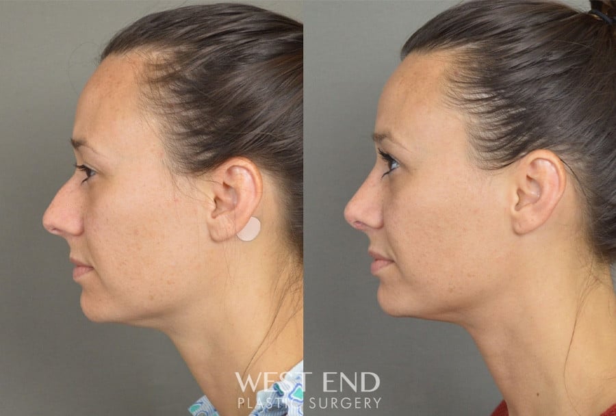 Rhinoplasty before photo. Individual results may vary.