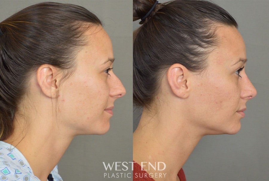 Rhinoplasty before photo. Individual results may vary.