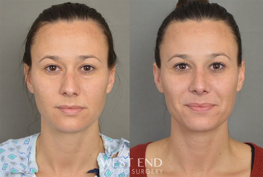 Rhinoplasty before photo. Individual results may vary.