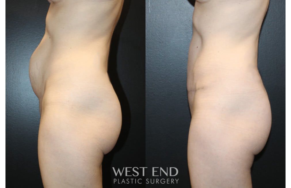Tummy Tuck
