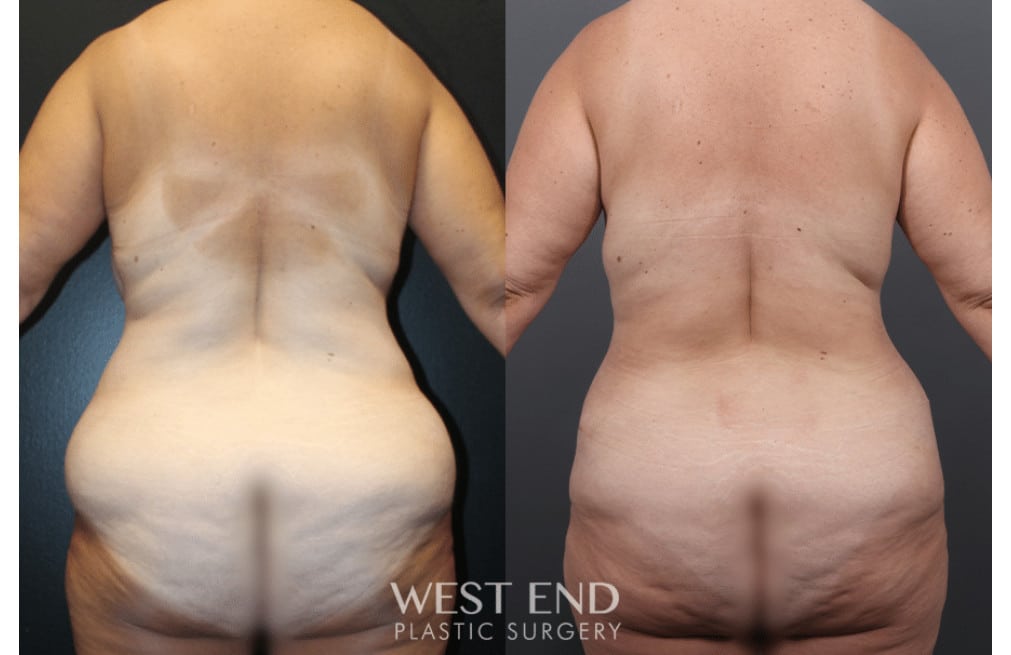 Mommy Makeover (Tummy Tuck & Breast Reduction)