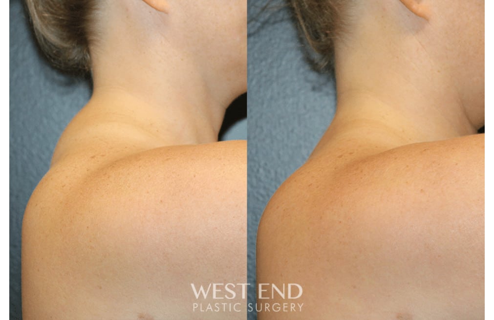 Liposuction