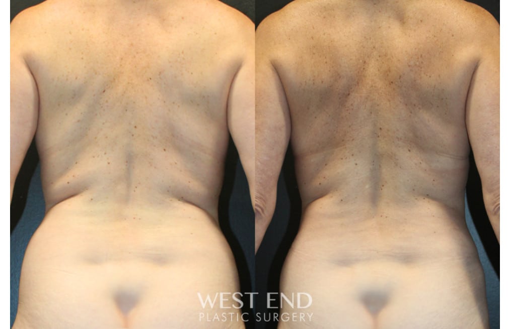 Liposuction and Renuvion Skin Tightening