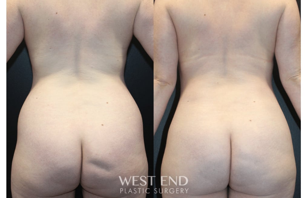 Cosmetic Fat Transfer