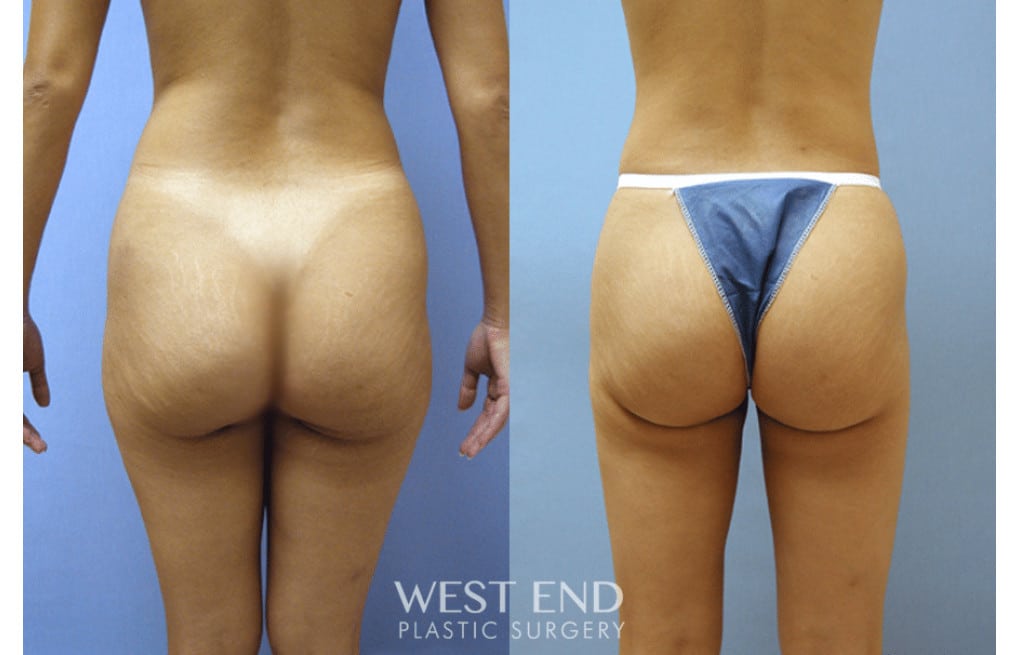 Brazilian Butt Lift