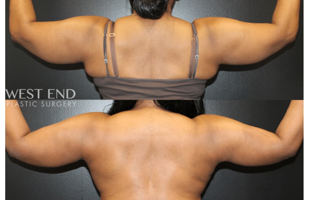 Liposuction and Renuvion Skin Tightening