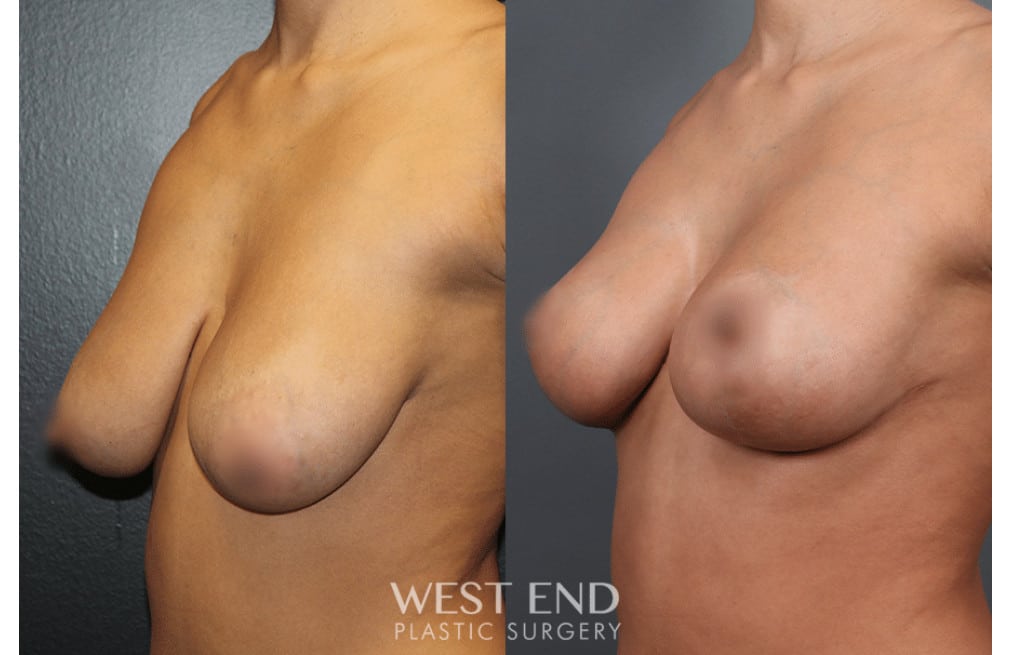 Breast Reduction and Lift