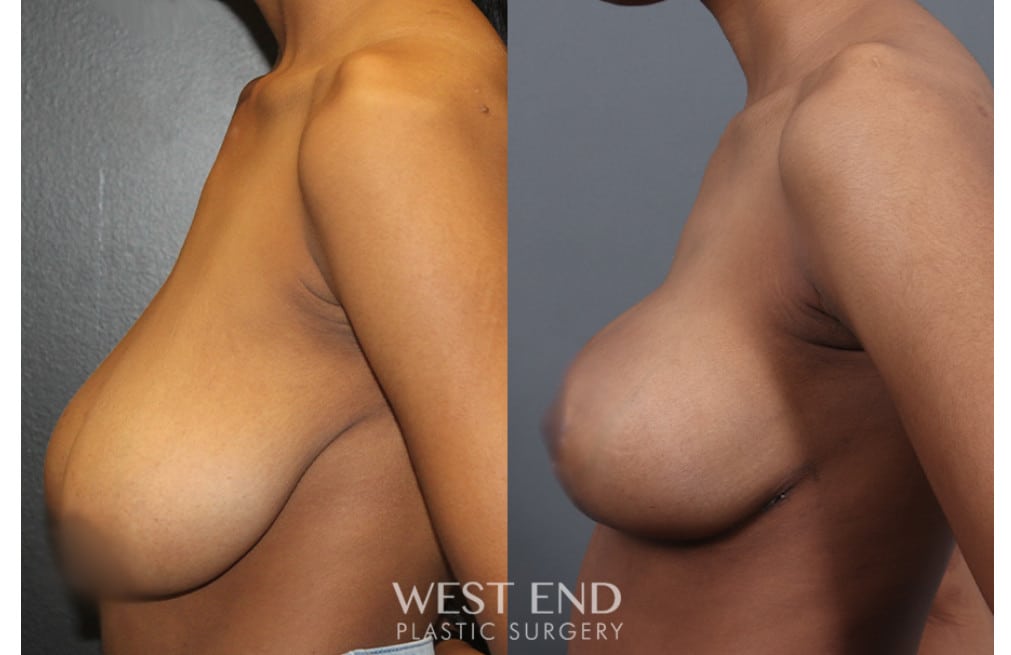 Breast Reduction