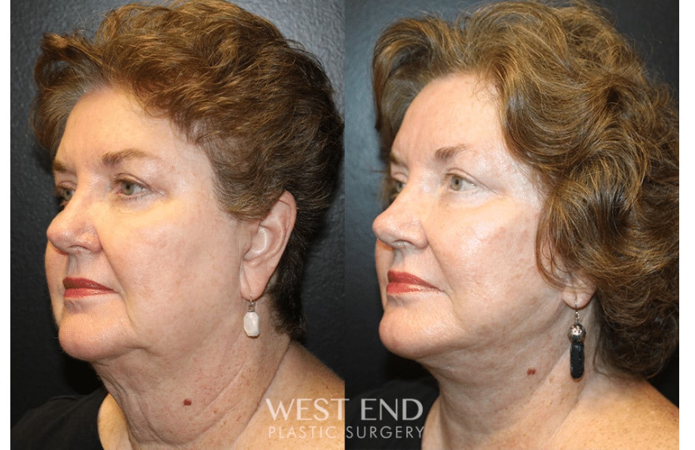 Facelift and Neck Lift