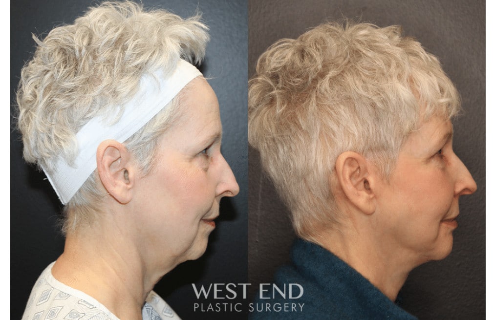 Facelift and Neck Lift