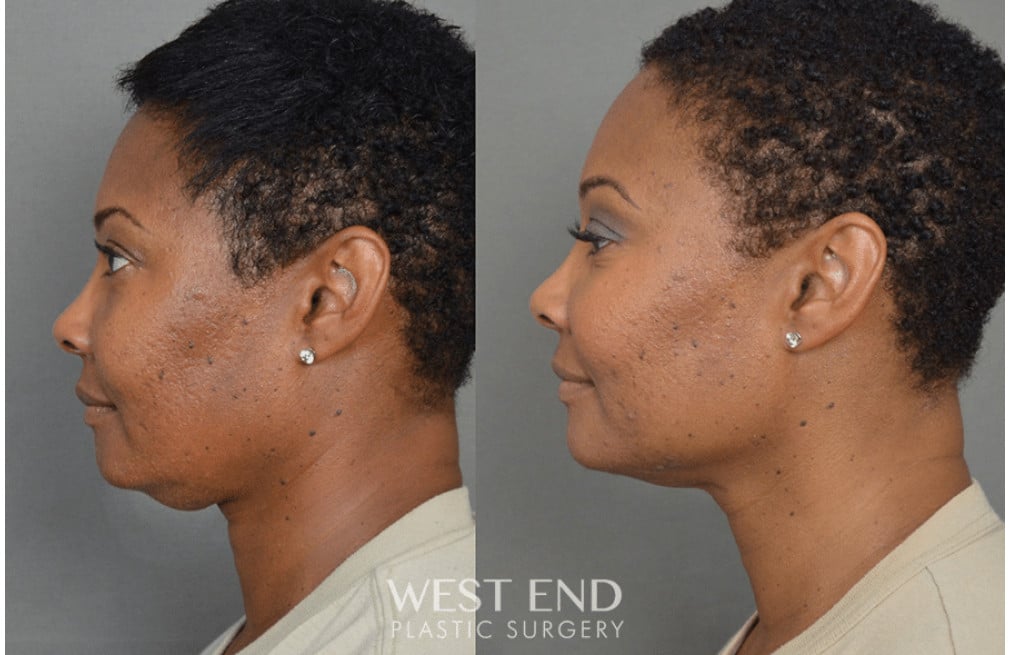 Chin Liposuction before photo. Individual results may vary.