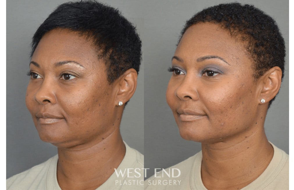 Chin Liposuction before photo. Individual results may vary.