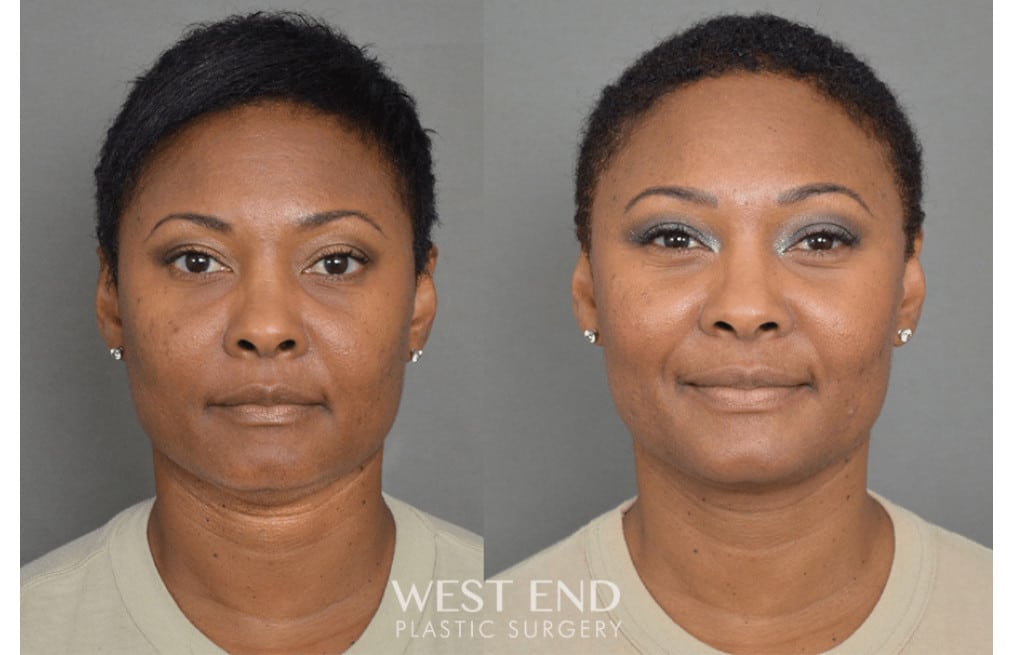 Chin Liposuction before photo. Individual results may vary.