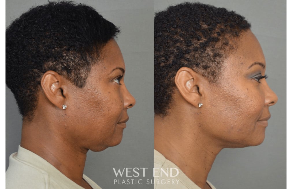 Chin Liposuction before photo. Individual results may vary.