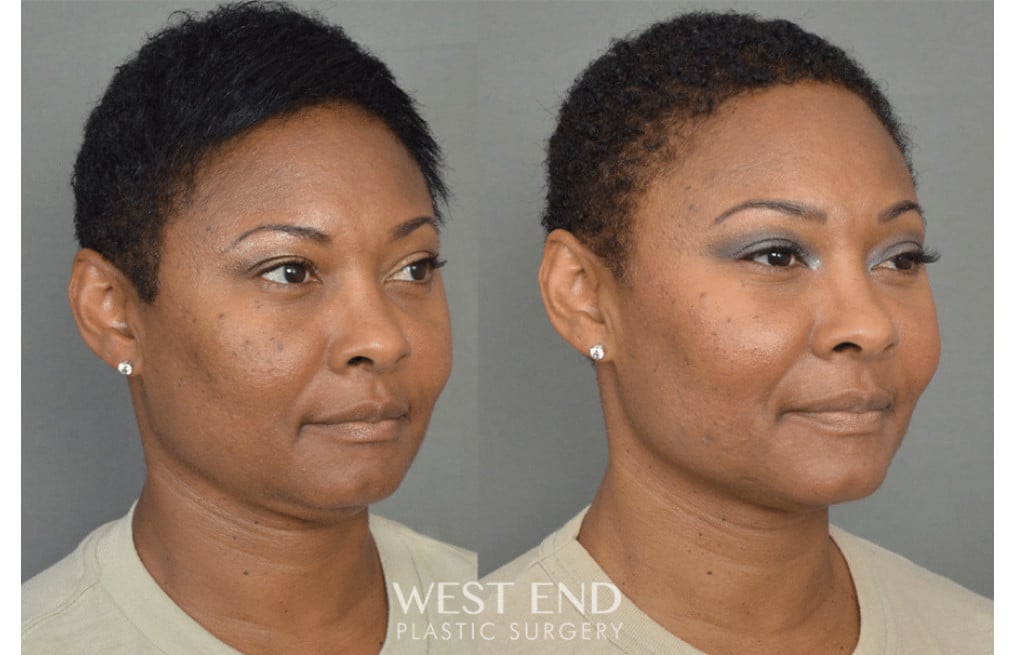 Chin Liposuction before photo. Individual results may vary.