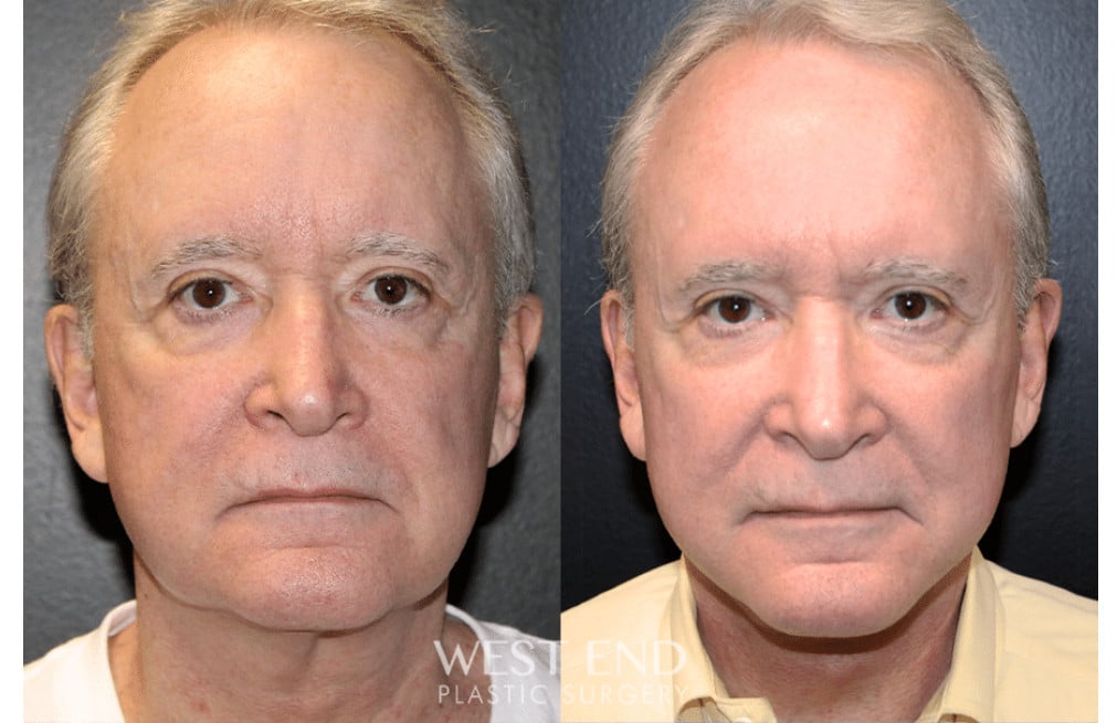 Neck Lift
