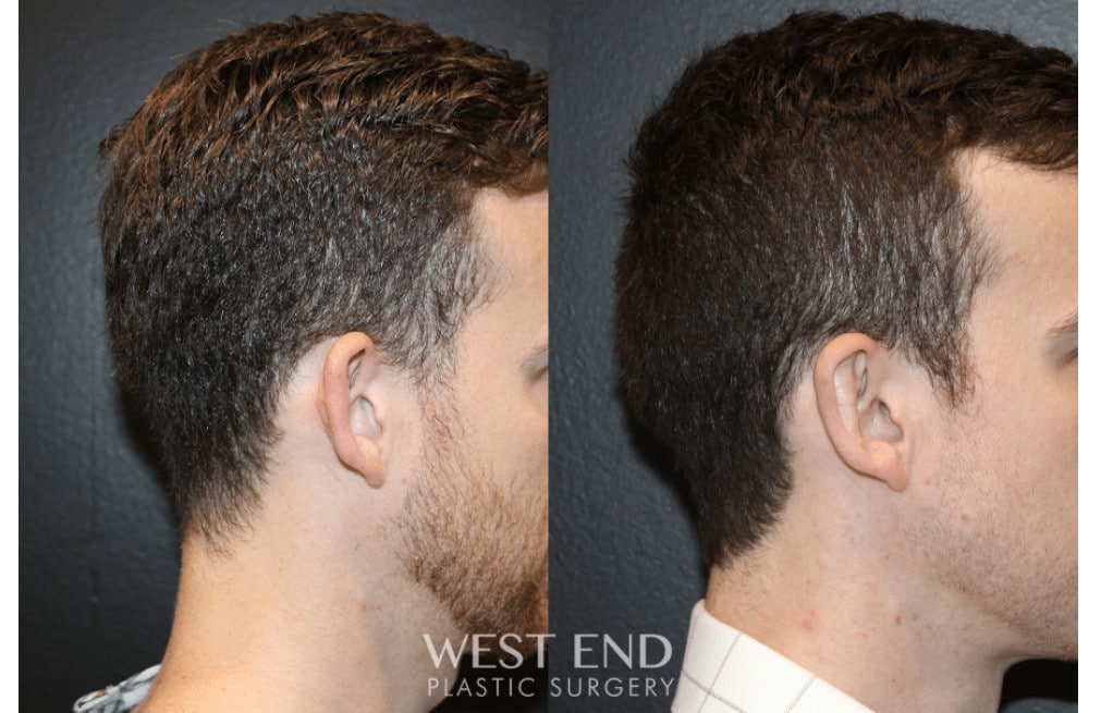 Otoplasty