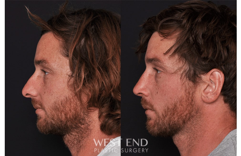 Septoplasty Rhinoplasty before photo. Individual results may vary.