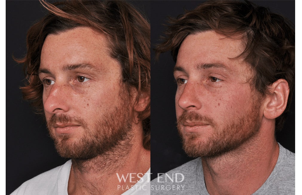 Septoplasty Rhinoplasty before photo. Individual results may vary.