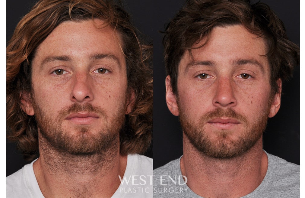 Septoplasty Rhinoplasty before photo. Individual results may vary.