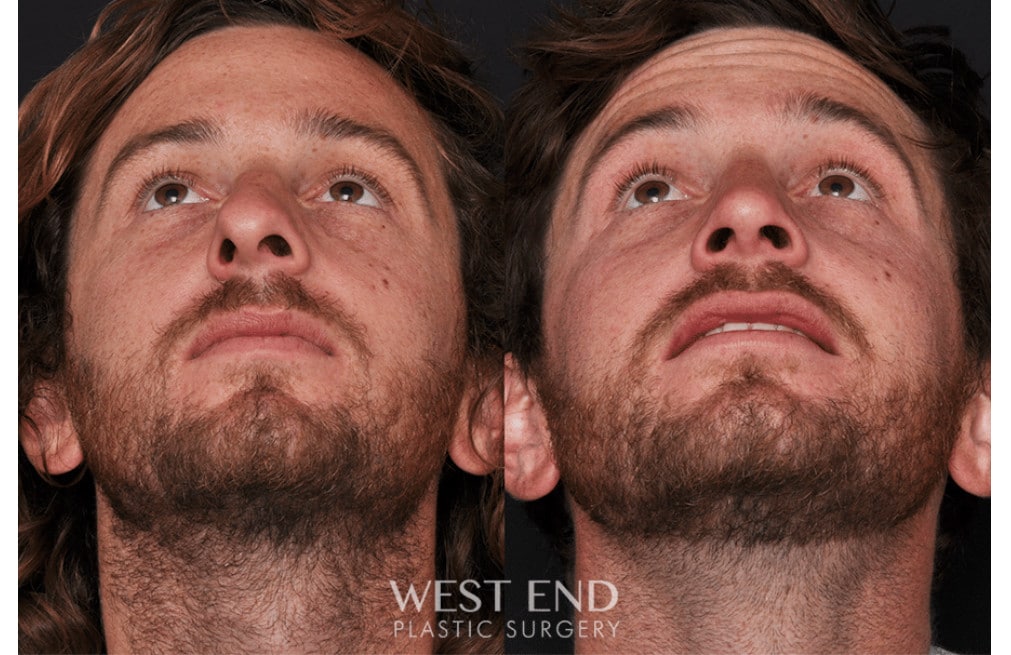 Septoplasty Rhinoplasty before photo. Individual results may vary.