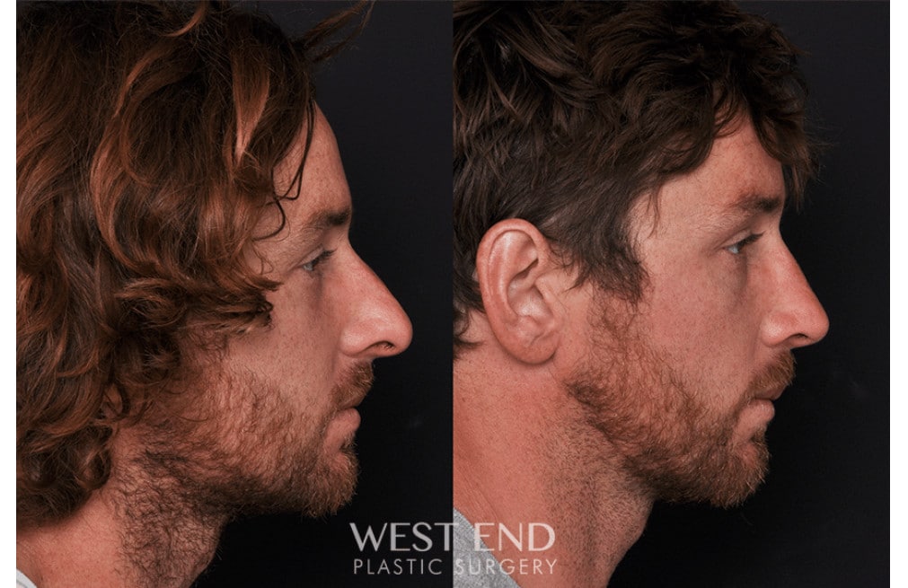 Septoplasty Rhinoplasty before photo. Individual results may vary.
