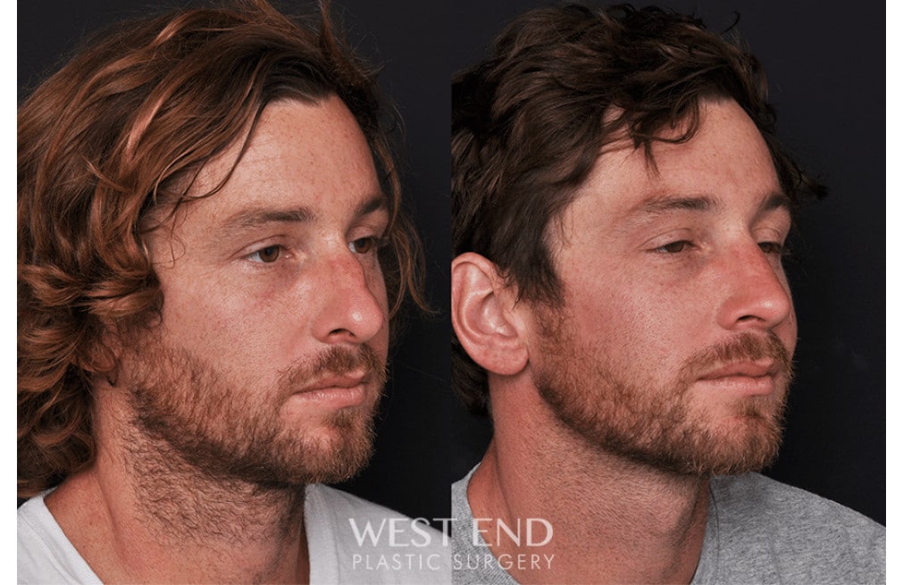 Septoplasty Rhinoplasty before photo. Individual results may vary.