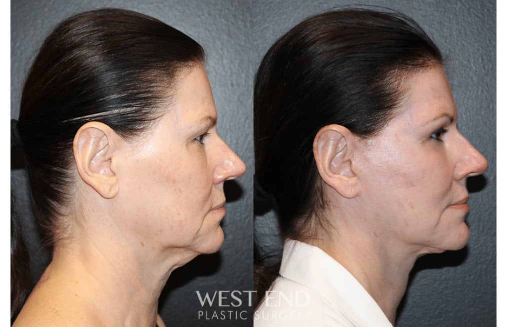 Facelift, Blepharoplasty, Fat Grafting, & CO2 Resurfacing