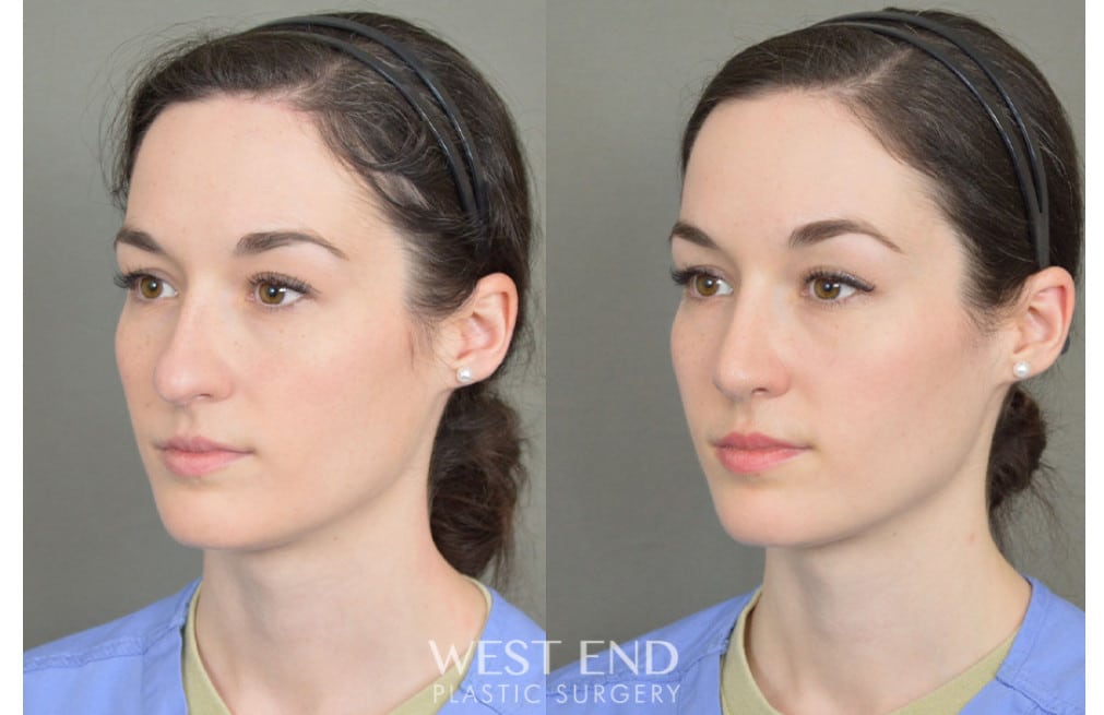 Rhinoplasty before photo. Individual results may vary.