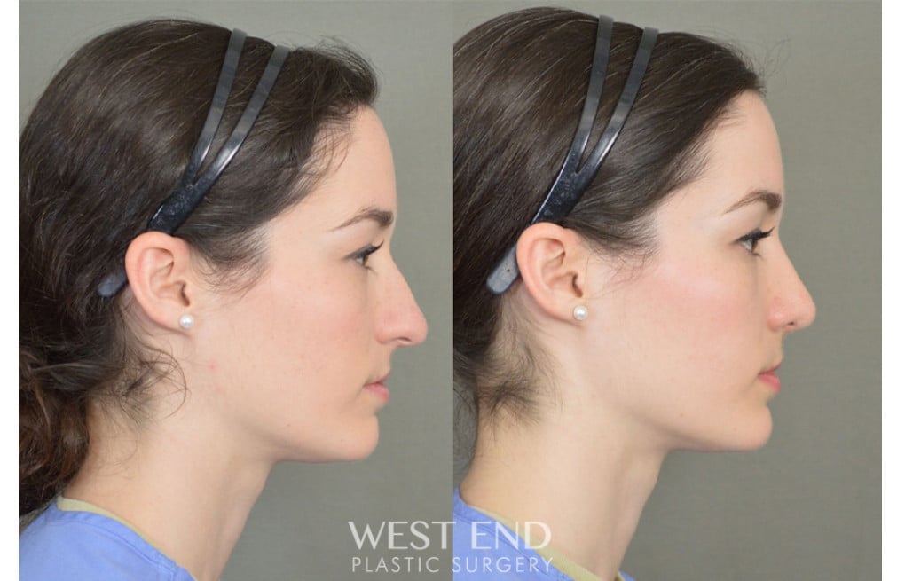 Rhinoplasty before photo. Individual results may vary.