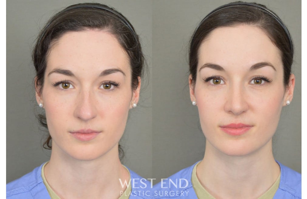 Rhinoplasty before photo. Individual results may vary.