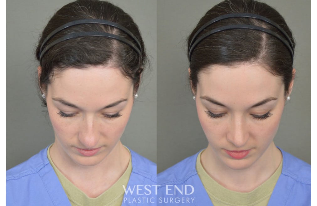 Rhinoplasty before photo. Individual results may vary.