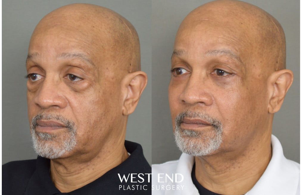 Blepharoplasty & Malar Implants before photo. Individual results may vary.