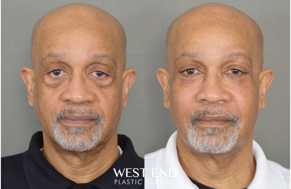 Blepharoplasty & Malar Implants before photo. Individual results may vary.