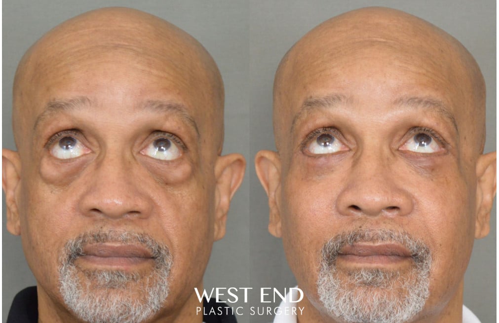 Blepharoplasty & Malar Implants before photo. Individual results may vary.