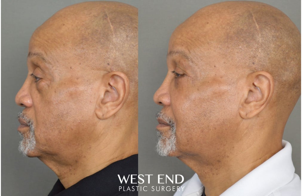 Blepharoplasty & Malar Implants before photo. Individual results may vary.