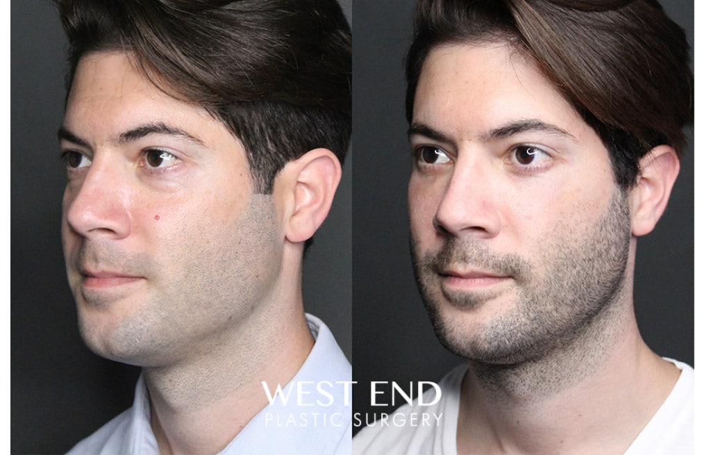 Blepharoplasty before photo. Individual results may vary.