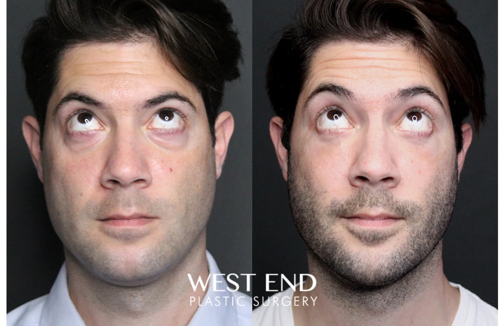 Blepharoplasty before photo. Individual results may vary.