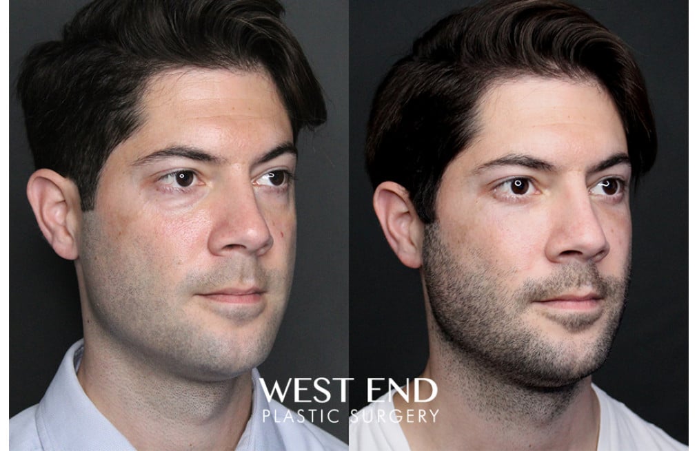 Blepharoplasty before photo. Individual results may vary.