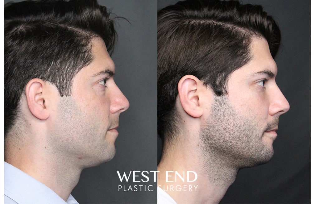 Blepharoplasty before photo. Individual results may vary.