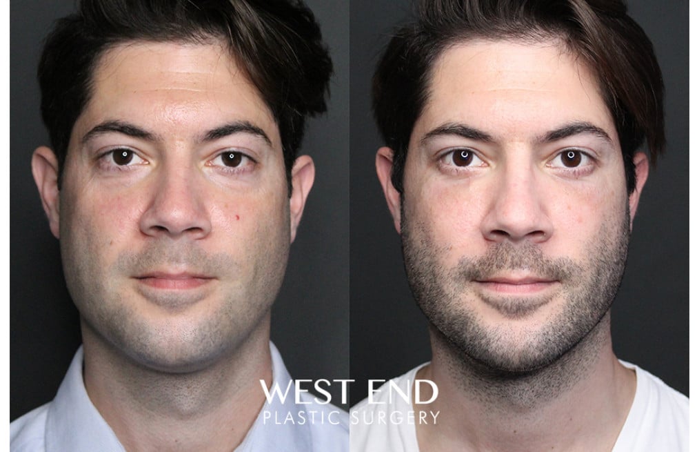 Blepharoplasty before photo. Individual results may vary.