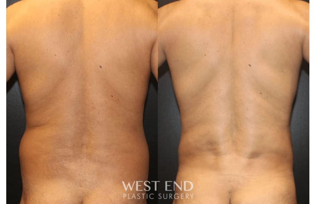 Hi Definition VASER Liposuction
