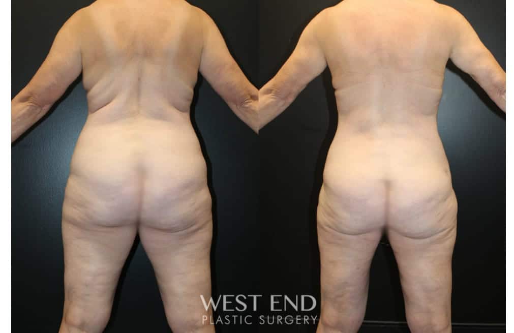 Liposuction and Renuvion Skin Tightening