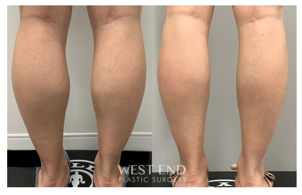 Calf Reduction with Botox