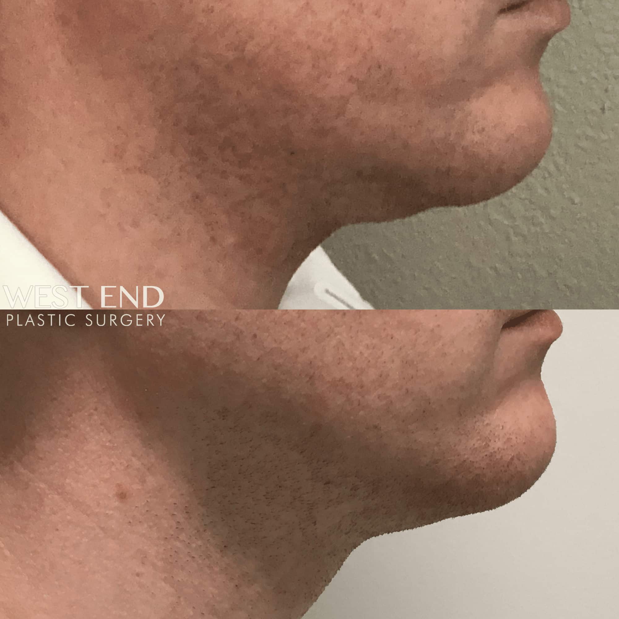 Kybella