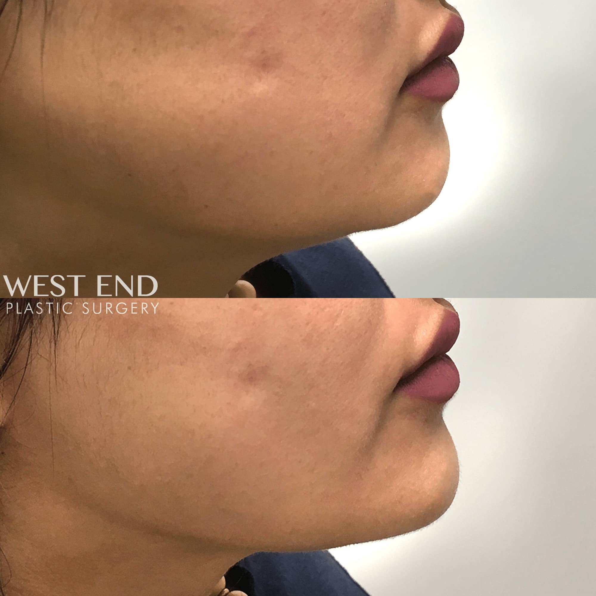 Chin Augmentation with Dermal Filler