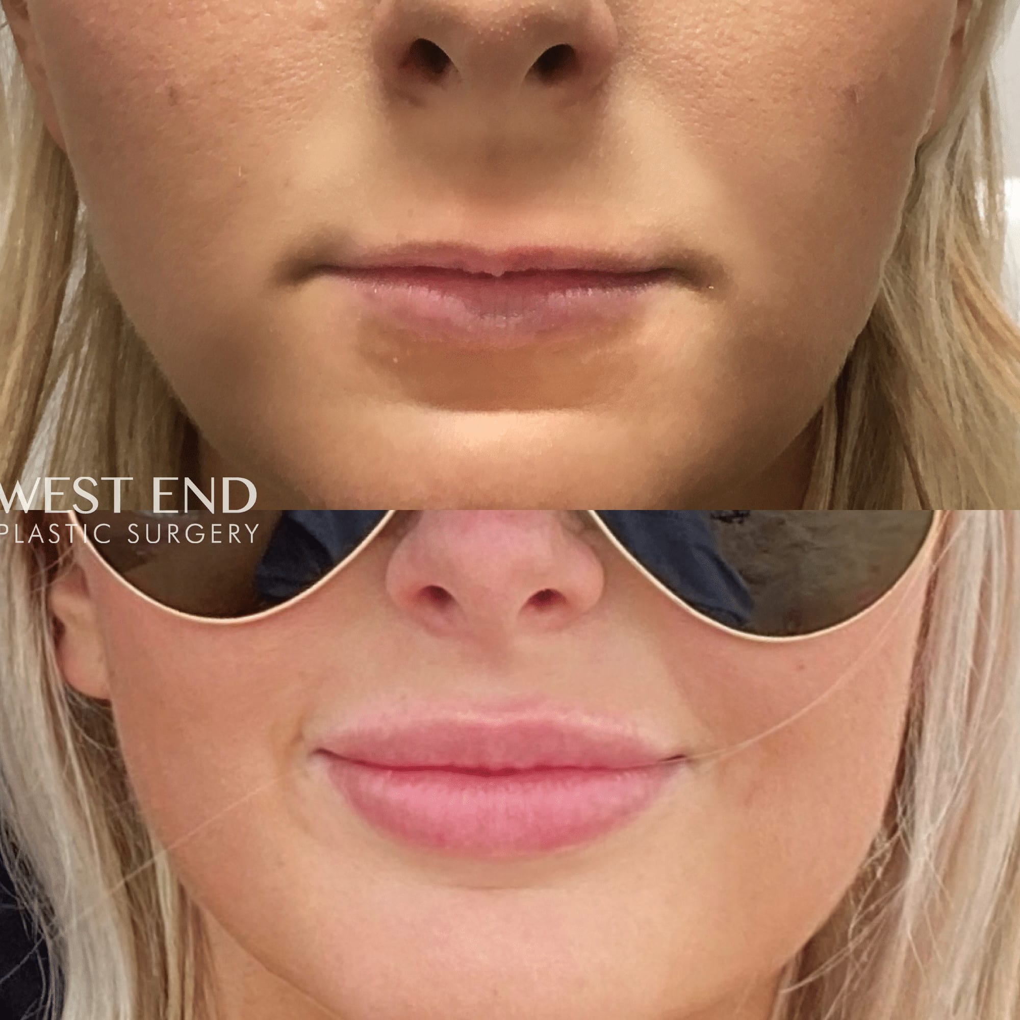 Lip Filler