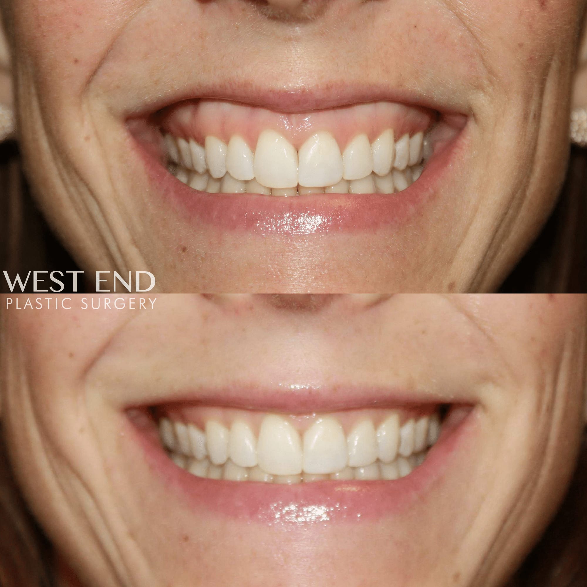 Neurotoxin for a “Gummy Smile”