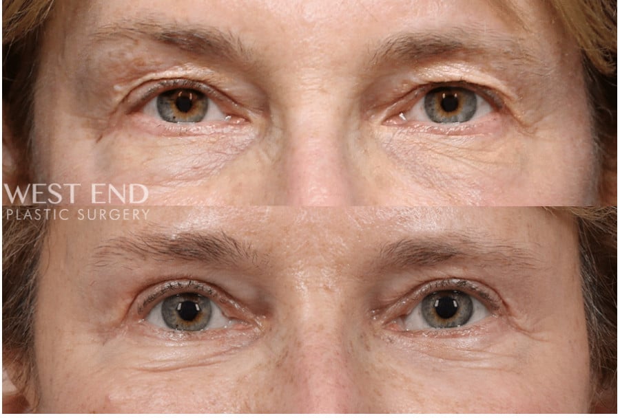 Blepharoplasty before photo. Individual results may vary.