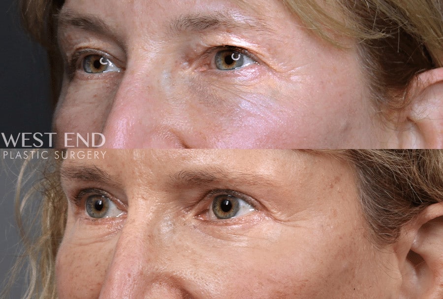 Blepharoplasty before photo. Individual results may vary.